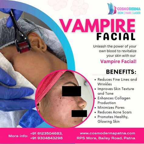 Rejuvenate Your Skin with the Vampire Facial at Cosmoderma Patna! Unleash the power of your own blood to revitalize your skin with our Vampire Facial! At Cosmoderma Patna, we use PRP (Platelet-Rich Plasma) therapy to stimulate collagen production, giving you a radiant, youthful complexion. ✨ Benefits of the Vampire Facial: - Reduces Fine Lines and Wrinkles - Improves Skin Texture and Tone - Enhances Collagen Production - Minimizes Pores - Reduces Acne Scars - Promotes Healthy, Glowing Ski... Platelet Rich Plasma Therapy, Vampire Facial, Platelet Rich Plasma, Textures And Tones, Minimize Pores, Collagen Production, Improve Skin Texture, Skin Texture, The Vampire