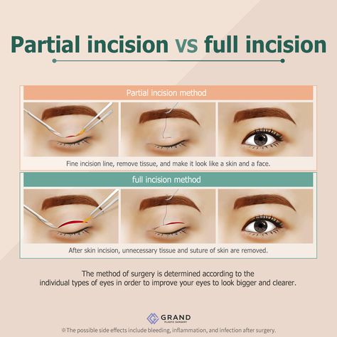 Make your eyes look bigger and more vivid with Grand`s incisional Double Eyelid Surgery! This method perfectly suits those, who have thicker skin, sagging skin as well as excessive fat on the eyelids. Find out all about Grand’s double eyelid surgery in this posting!  For online consultation🎀 Tel: (+82) 70-7119-1580 Mobile: (+82) 10-9132-6546 (Whatsapp, Line, Kakaotalk, Viber, iMessage) Email: grandps.en@gmail.com Facebook: Grand Plastic Surgery, Korea Website: eng.grandsurgery.com Pinterest : h Eyes Surgery, Plastic Surgery Korea, Make Your Eyes Look Bigger, Eyes Look Bigger, Plastic Surgery Procedures, Online Consultation, Double Eyelid, Thick Skin, Sagging Skin