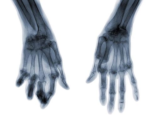 There are 206 bones in the human body. The hands and feet have more than half of them - 106 total.Now that you know what your hands look like under an x-ray... Half Skeleton Half Human, 206 Bones, Half Skeleton, X-ray Images, X Rays, The Human Body, X Ray, Daily News, Art Project