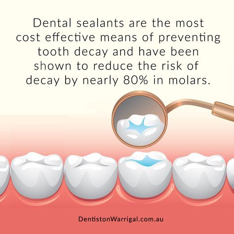 Dental Assistant Study, Dental Sealants, Dental Images, Family Dental Care, Dental Aesthetics, Dental Hygiene School, Dental Fun, Dental Surgeon, Dental Facts