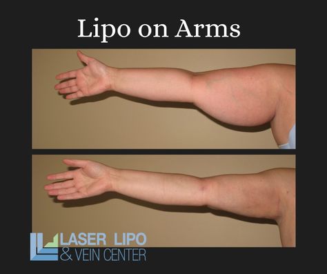 Arm and Underarm Liposuction: Achieve Slim, Contoured Arms at St. Louis Lipo - St Louis Lipo Lipo 360 Before And After Stomach, Arm Lipo Before And After, Lipo 360 Before And After, Lipo Before And After, Fat Transfer, Excess Skin, Laser Skin, Fat Removal, Fat Reduction