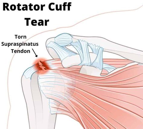 Top 6 Shoulder Rotator Cuff Exercises for Beginners Shoulder Rotator Cuff Exercises, Rotator Cuff Tear Exercises, Shoulder Pt Exercises, Exercises For Rotator Cuff Pain, Rotator Cuff Exercises Physical Therapy, Torn Rotator Cuff Exercises, Isometric Shoulder Exercises, Rotator Cuff Injury Exercises, Rotator Cuff Strengthening