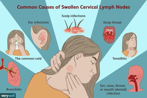 Enlarged Cervical Lymph Nodes Lymph Nodes In Neck, Cervical Lymph Nodes, Tonsils And Adenoids, Sternocleidomastoid Muscle, Internal Carotid Artery, Lymph Node, Dental Infection, Strep Throat, Tooth Pain