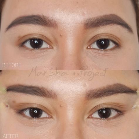 Fox Eye Before And After, Cat Eye Surgery Before And After, Cat Eye Surgery, Fox Eye Surgery Before And After, Fox Eye Surgery, Eyes Surgery, Eye Lift Surgery, Face Plastic Surgery, Natural Skin Tightening