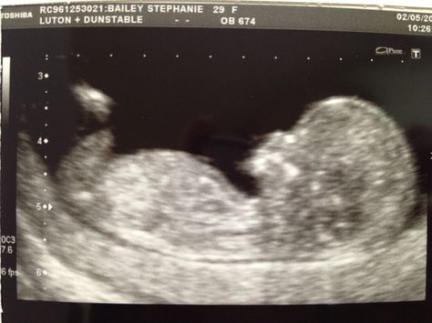 12 week scan! 12 Week Scan, 12 Weeks, Ultrasound, Quick Saves