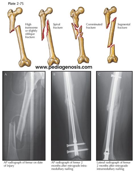 Types Of Fractures, Hamstring Muscles, Musculoskeletal System, Organ System