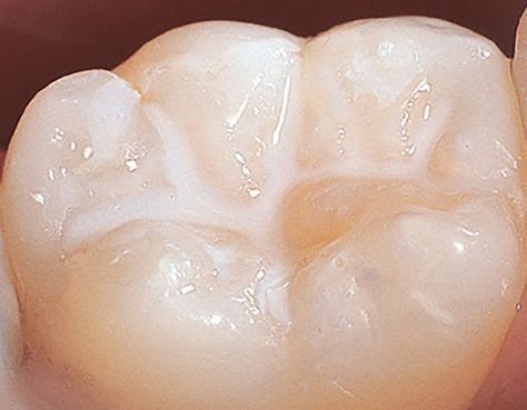 Dental Sealants, Dental World, Dental Decay, American Dental Association, Pediatric Dental, Pediatric Dentistry, Dental Surgery, Natural Teeth, Dental Practice