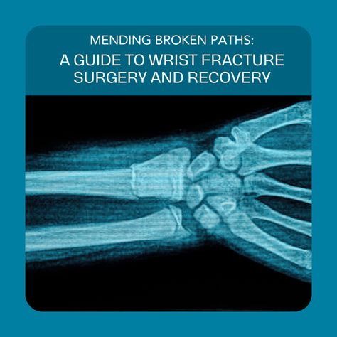 "Discover the journey through wrist fracture surgery and recovery in this comprehensive guide. Whether you've experienced it firsthand or want to learn more, dive into the process step by step. Trust in modern medical advancements and the supportive community at Monadnock Community Hospital. Together, we heal. Wrist Fracture, Recovery From Surgery, Road To Recovery, Community Hospital, Orthopedic Surgery, Medical Coding, Surgery Recovery, The Process, The Journey