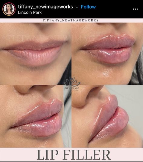 Bow Shaped Lips Filler, Lip Filler Cupids Bow, 1 Syringe Lip Filler Before And After, Lip Injections Shapes, Hip Filler, Bow Shaped Lips, Lip Filler Styles, 0.5 Ml Lip Filler Before And After, Lip Filler Shape Ideas