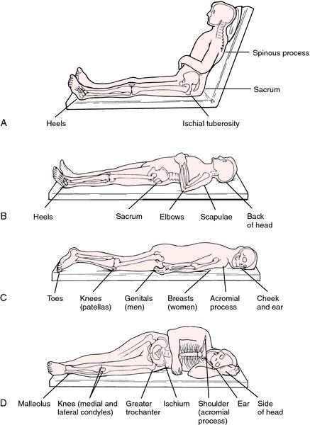 Decubiti - definition of Decubiti in the Medical dictionary - by the Free Online Medical Dictionary, Thesaurus and Encyclopedia. Diseases Pictures, Back Spasm, Physical Therapy Student, Medical Dictionary, Bed Sores, Pressure Ulcer, Peer Support, Medical Terms, Wound Care