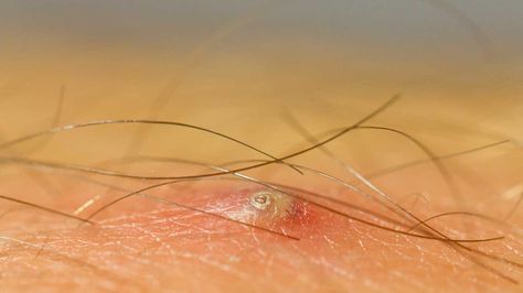 Ingrown Hair on Butt: Symptoms, Causes, Remedies Ingrown Hair Removal Videos, Skin Boil, Infected Ingrown Hair, Ingrown Hair Remedies, Bump Hairstyles, Ingrown Hair Removal, Ingrown Hairs, Face Wrinkles, Acupressure Points