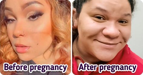 Pregnancy causes noses to grow, and for some women, this is the thing that they totally weren’t prepared for. There’s even a new TikTok trend where women are sharing their before and after pictures with the hashtag “pregnancy nose.” Some of them look like totally different people in their before snaps compared to their after-pregnancy photos. Our featured heroine faced this challenge too. And to some extent, it wasn’t just her nose changed, but her whole face started looking like someone else’s. Pregnancy Before And After Photos, Before And After Pregnancy Photos, Pregnancy Nose, Hospital Pictures, Different People, Like Someone, After Pictures, First Trimester, Just She