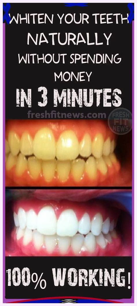 Delightful valuable information. Teeth Whitening Methods, Teeth Whitening Homemade, Get Whiter Teeth, Teeth Whitening Remedies, Teeth Whitening Diy, Pasta Dental, Yellow Teeth, Best Teeth Whitening, Receding Gums