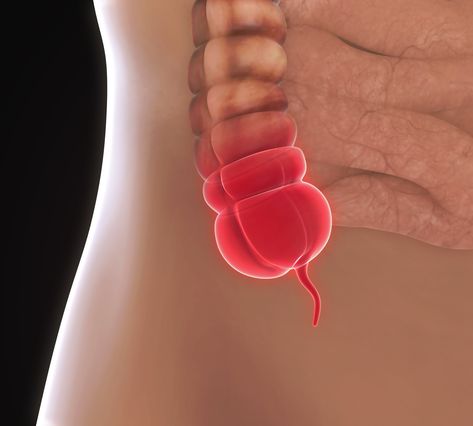 Appendicitis can strike at any age. Symptoms of an inflamed appendix can mimic other problems, and it’s always an emergency. Here’s what you need to know. Appendix Surgery, Laparoscopic Surgery, Bloated Belly, Cleveland Clinic, Stomach Ache, Family Medicine, Stomach Pain, Medical Help, Eat Fruit