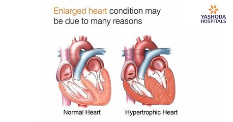 Enlarged Heart: Heart Enlargement Causes | Signs of Enlarged Heart Heart Symptoms, Enlarged Heart, Throbbing Headache, Normal Heart, Congenital Heart, Heart Care, Coronary Arteries, Heart Conditions, Migraine Headaches