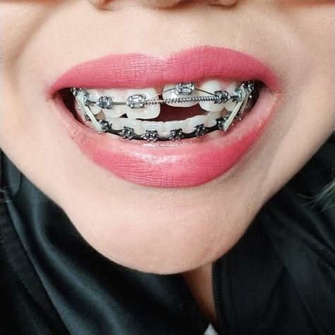 #braces #girlswithbraces #metalbraces #elastics #powerchain #springs Braces Colors Ideas Power Chains, Power Chains, Braces Girl, Braces Before And After, Braces Colors Ideas, Adult Braces, Braces Girls, Chains Silver, Orthodontic Appliances