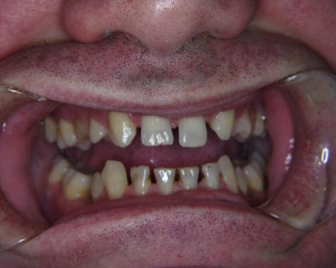 Spaces between teeth resulting from congenitally missing teeth Space Between Teeth, Rotten Teeth, Teeth Pictures, Senior Thesis, Missing Teeth, Being Ugly, Twins