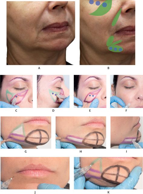 Chin Filler Injection, Aesthetic Injections, Face Injections, Filler Injection, Facial Veins, Attractive Face, Botox Brow Lift, Chin Filler, Skin Anatomy