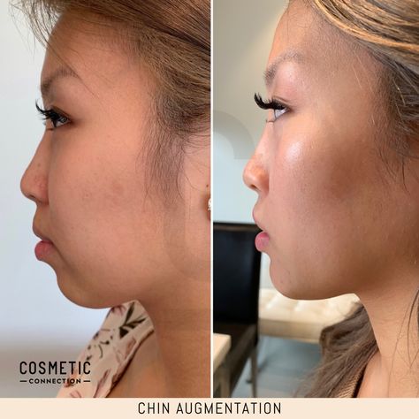 A non-surgical chin augmentation can reshape your chin using dermal fillers. It can improve facial balance and jawline definition, correct asymmetry, improve a double chin and add projection to a weak or small chin. Chin dermal fillers also improve the side profile by bringing the nose and lips into balance.⁠ ⁠ If you're interested in having a chin augmentation, then follow the link in the bio to secure your appointment today!⁠ Confidence looks good®⁠ Profile Balancing Fillers, Weak Chin Profile, Small Chin, Weak Chin, Chin Augmentation, Diet Schedule, Yoga Information, Chin Chin, Excess Hair