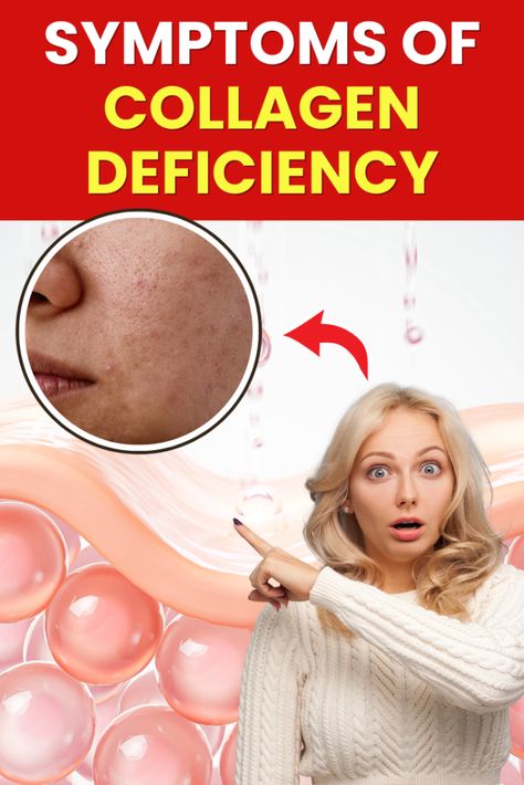 ✨ 6 Symptoms of Collagen Deficiency
 ✨  
Wondering if you're missing out on the benefits of collagen? Discover the common signs that could be affecting your skin, joints, and overall health. Learn how to spot these symptoms and boost your collagen levels naturally! 🌿 #HealthTips #SkinCare #Wellness #Collagen #HealthyLiving Collagen Deficiency Symptoms, Collagen Benefits Before And After, What Is Collagen Good For, Natural Ways To Boost Collagen, Natural Sources Of Collagen, Why Collagen Is Important, Health Benefits Of Collagen, Metabolism Foods, Ketogenic Desserts