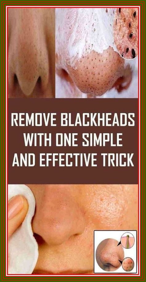 Remove Blackheads With One Simple And Effective Trick Prevent Pimples, Get Rid Of Warts, Remove Blackheads, Natural Health Care, Natural Cold Remedies, Get Rid Of Blackheads, Natural Cough Remedies, Cold Home Remedies, Cold Remedies