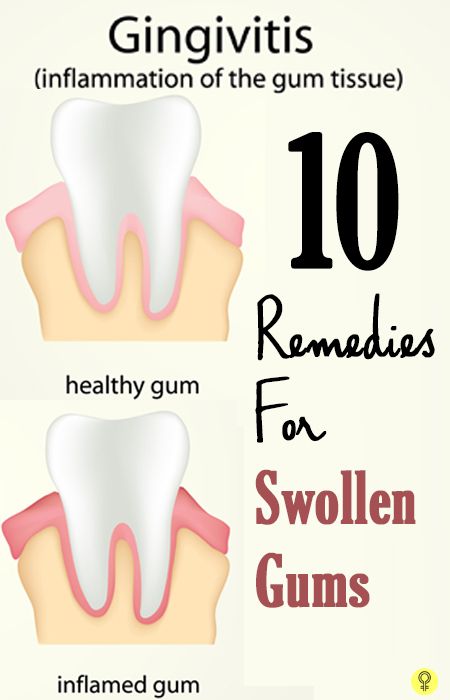 Do you suffer from swollen gums? If you do, you probably often go through a lot of discomfort and pain. Here are some effective home remedies for you to know Swollen Gum, Teeth Health, Receding Gums, Gum Health, Teeth Care, Oral Health Care, Simple Home, Tooth Decay, Healthy Teeth