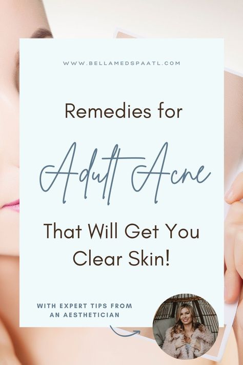 Want to stop dealing with adult acne breakouts and scars? Adult acne is never fun, and if you're wondering what is causing acne as well as how to deal with a flare up or acne breakouts, here are the best natural remedies for acne! Natural Remedies For Acne, Remedies For Acne, Hormonal Breakouts, Natural Acne Remedies, Healthy Skin Tips, Acne Breakout, Acne Remedies, Med Spa, Skin Tips