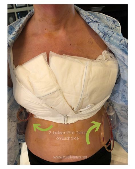 Mastectomy and Recovery: What it is really like Mastectomy Drains, Mastectomy Scar Tattoo, Mastectomy Reconstruction, Mastectomy Surgery, Mastectomy Scars, Mastectomy Recovery, Bilateral Mastectomy, Mastectomy Tattoo, Chemo Care