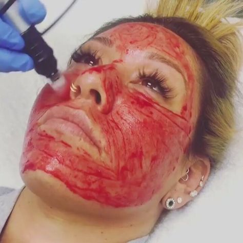 Beauty Insider on Instagram: “Via @thisisinsiderfitness: The vampire facial is a bloody good way to rejuvenate your skin. 💉 #beautyinsider @silviambeauty” Vampire Facial, Facial Wrinkles, Small Faces, Beauty Inside, The Vampire, Beauty Trends, Healthy Skin, Carnival Face Paint, Your Skin