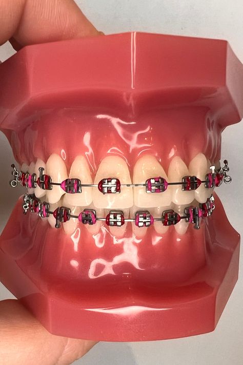 Are you ready to make a bold statement with your braces? Choosing red and pink braces bands is one way to do it! Discover 21 amazing red braces combinations that will turn heads and showcase your unique style. Say goodbye to boring and embrace a vibrant braces journey – you deserve it! Learn more inside the article. Red Braces Color, Braces Combos, Braces Color Combos, Power Chain Braces, Braces Journey, Braces Colors Combinations, Pink Braces, Diy Braces, Red Braces