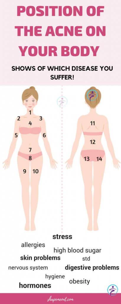 Did you know that the area of your face or body where you have been noticing acne outbreaks the most may actually indicate some internal problem? Also known as facial mapping, this method is the ideal way to determine the possible root cause of your acne. Facial Mapping, Face Mapping Acne, Acne Products, Body Toxins, Face Mapping, Acne Causes, Hormonal Acne, Face Acne, Body Organs