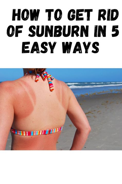 Women with a sunburn Get Rid Of Sunburn, Caught Out, Summer Plans, On Holiday, The Sunshine, Summer Sun, Top Tips, 5 Ways, Sun Lounger