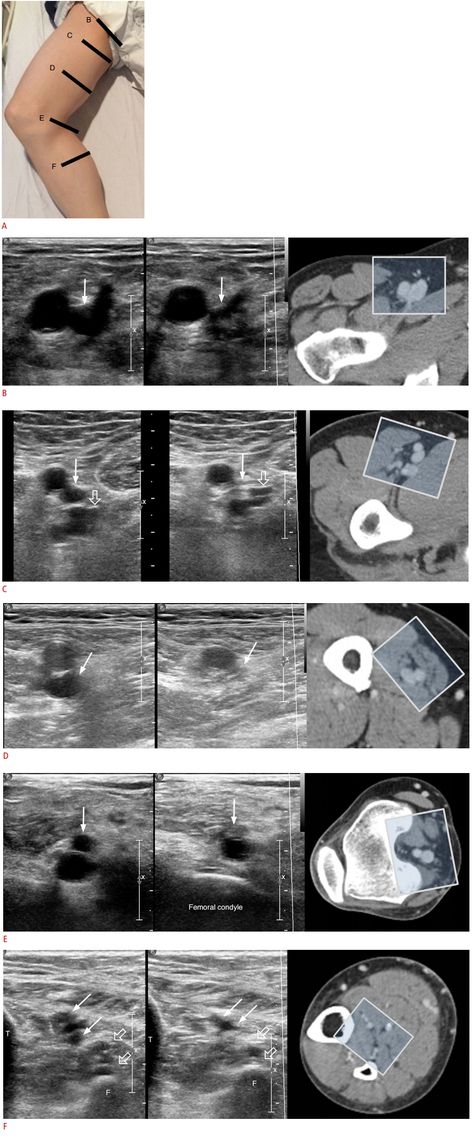 Lower Extremity Venous Ultrasound, Cardiovascular Sonography, Ultrasound School, Valsalva Maneuver, Academic Journal, Vascular Ultrasound, Medical Sonography, Language Journal, Medical Ultrasound