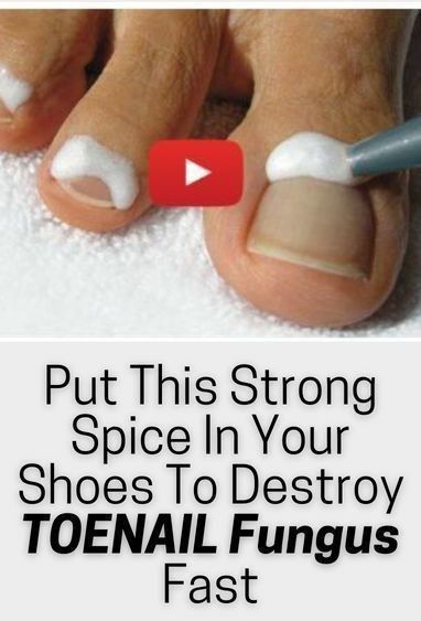 Infected Toenail, Toenail Fungal Infection, Nail Remedies, Fingernail Fungus, Toenail Fungus Remedies, Nail Infection, Nail Fungus Remedy, Fungal Nail, Ingrown Toe Nail