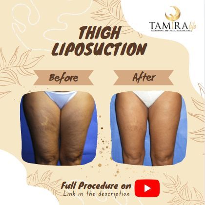 liposuction, thigh reduction, Before After #Vaserlipo #vaserliposuction #liposuction #thighreduce #thighliposuction #fatreductiontreatment #Fatreduce #fatfreezetreatment #coolsculpting #tamiralife #laserclinic #cosmetology #transformation #plasticsurgery Botox Injection Sites, Vaser Lipo, Lipo Before And After, Feeling Uncomfortable, Laser Clinics, Botox Injections, Cool Sculpting, Thigh Fat, Fat Removal