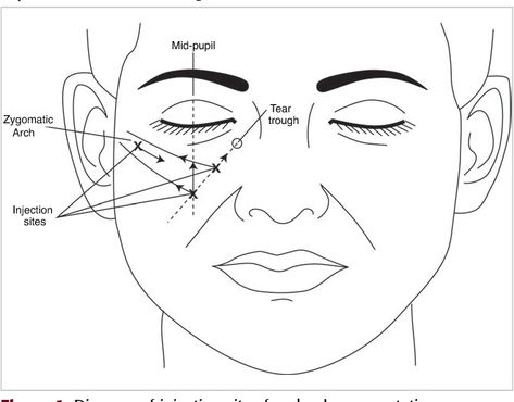 Face Injections, Botox Injection Sites, Skin Fillers, Dermal Fillers Lips, Injection Sites, Botox Injection, Derma Fillers, Face Fillers, Aesthetic Dermatology