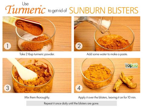 How to Get Rid of Sunburn Blisters | Top 10 Home Remedies Sun Blisters, Sunburn Blisters, Water Blister, Blister Remedies, How To Heal Blisters, Get Rid Of Sunburn, Natural Wart Remedies, Sunburn Peeling, Heal Sunburn