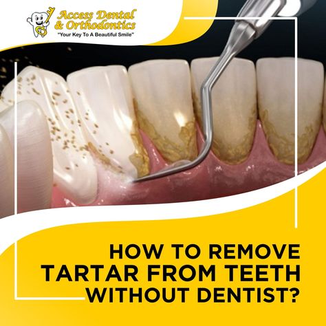 How to Remove Plaque & Tartar From Teeth (Without Dentist) Diy Tartar Removal Teeth, How To Remove Plaque From Teeth, How To Clean Plaque From Teeth, Diy Plaque Remover Teeth, How To Get Plaque Off Teeth, Removing Plaque From Teeth At Home, How To Get Rid Of Tartar Build Up, How To Remove Tartar From Teeth At Home, How To Remove Tartar From Teeth