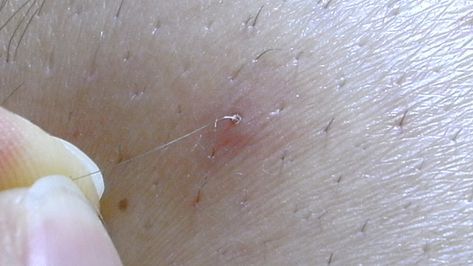 Treating and Preventing Ingrown Pubic Hair: What to Avoid Infected Hair Follicle, Get Rid Of Mucus, Infected Ingrown Hair, Getting Rid Of Mucus, Ingrown Hair Removal, Prevent Ingrown Hairs, Ingrown Hairs, Hair Starting, Ingrown Hair