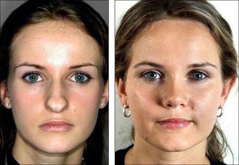 Bulbous Tip Rhinoplasty Before After, Rhinoplasty Bulbous Tip, Bulbous Tip Rhinoplasty, Bulbous Nose Rhinoplasty Before After, Celebrity Rhinoplasty, Bulbous Nose Rhinoplasty, Tip Rhinoplasty, Facial Harmony, Nose Surgery Rhinoplasty