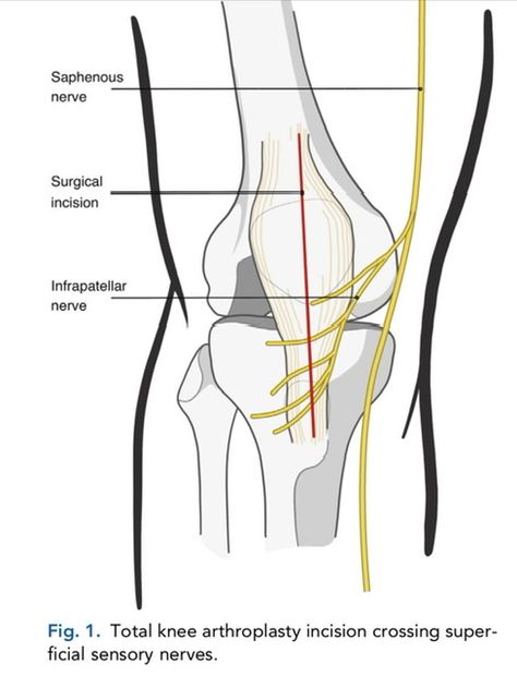 What Wear After Knee Replacement Surgery Siatic Nerve, After Knee Replacement Surgery, Knee Anatomy, Nerve Pain Remedies, Knee Replacement Exercises, Knee Replacement Recovery, Knee Replacement Surgery, Nerve Pain Relief, Knee Exercises