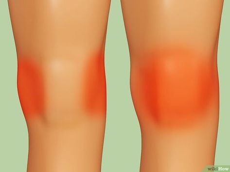 How to Heal a Meniscus Tear (with Pictures) Torn Medial Meniscus Relief, Torn Medial Meniscus, Aching Knees, Fascia Blasting, Meniscal Tear, Yoga For Sciatica, Ways To Heal, Lymph Fluid, Physical Therapy Exercises