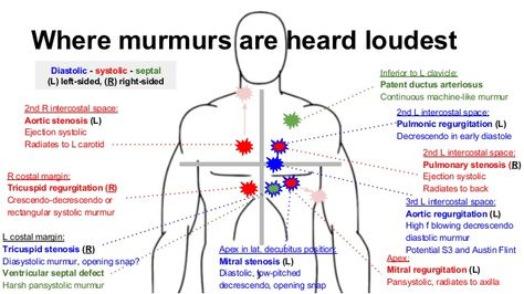 Where murmurs are heard loudest 2nd L intercostal space: Pulmonary stenosis (R) Ejection systolic Radiates to back Inferio... Np School, Heart Sounds, Family Nurse Practitioner, Cardiac Nursing, Critical Care Nursing, Nursing School Studying, Medical School Studying, Nursing School Notes, Medical School Essentials