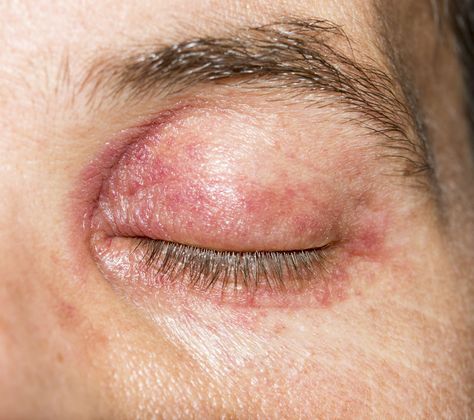 Learn about eyelid dermatitis, including types, causes, symptoms, and prevention, and how to get rid of these itchy, dry eyelid rashes. Itchy Eyelids, Dry Eyelids, Skin Cream Anti Aging, Itchy Rash, Itchy Eyes, Skin Specialist, Skin Treatments, Allergies, Medicine