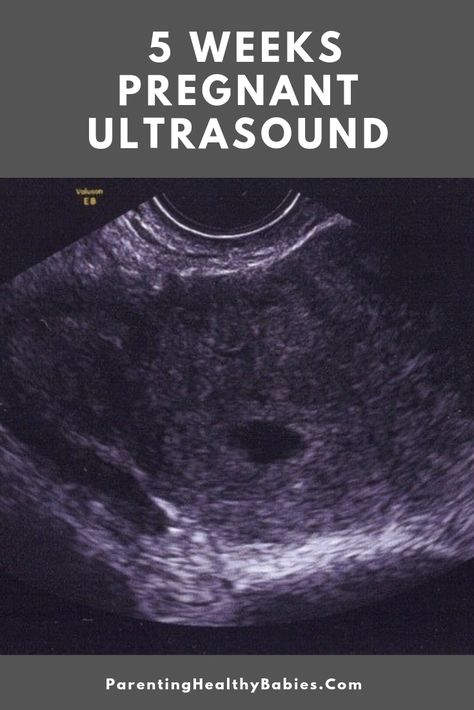 5 Week Ultrasound Pictures, 5 Weeks Pregnant Ultrasound, Week 5 Pregnancy, Five Weeks Pregnant, Twins Ultrasound, 5 Weeks Pregnant, Fetal Heart Rate, Pregnancy Ultrasound, Having Twins