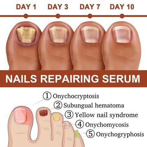 【✨Last Day 50% OFF✨】GFOUK™7-day nail growth and strengthening serum Nail Growth Faster, Nail Disorders, Grow Long Nails, Fast Nail, Nail Serum, Natural Nail Care, Weak Nails, Nail Repair, Nail Growth