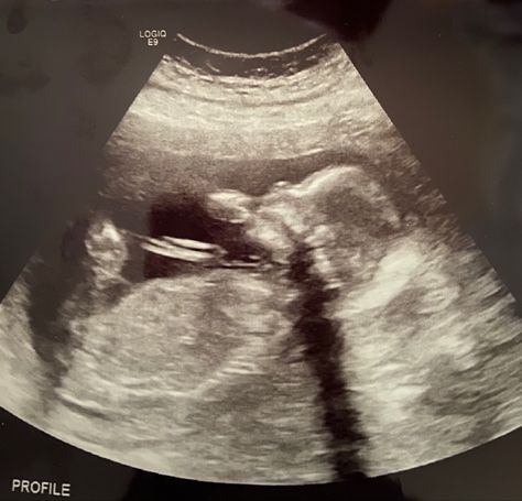 Baby Boy ultrasound picture at 20 weeks Baby Boy Ultrasound Pictures, 20 Week Ultrasound Pictures, Boy Ultrasound Pictures, Boy Ultrasound, 20 Week Ultrasound, 3d Ultrasound Pictures, Fake Ultrasound, Mario Rodriguez, Sonogram Pictures