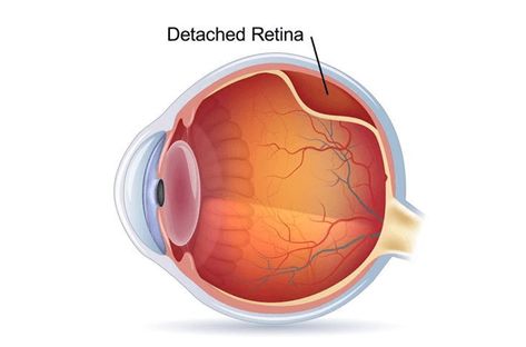 That is a state where the retina of the eye attracts besides its regular place, affecting eyesight. Occasionally only tiny pieces of it's going to tear away - they're known as retinal tears or fractures but that could lead to detachment too. When it occurs, vision is badly affected. If it goes untreated, it is going to spread to neighbouring areas and hitting out the macula, it is going to lead to loss of vision. #surgery #retina Eye Medicine, Eye Tricks, 20 20 Vision, Eye Sight Improvement, Vision Problems, Fix You, The Eye, Fix It, Surgery