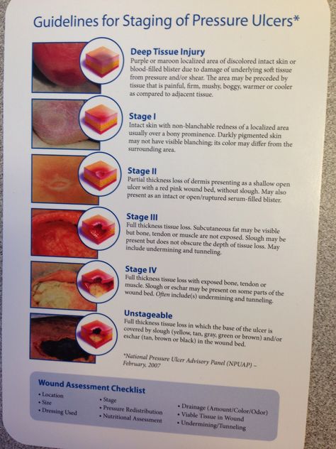 Staging Pressure  Ulcers Wound Assessment, Pressure Ulcer Staging, Wound Care Nurse, Wound Care Nursing, Medical Assisting, Nursing Information, Nursing Assessment, Pressure Ulcer, Hospice Nurse