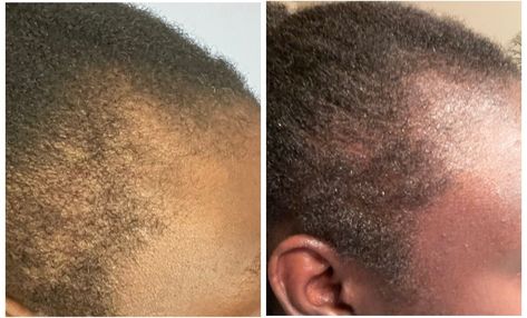 Breakage Hair, Before And After Hair, Receding Hair Styles, Fast Hair Growth, Growing Hair, Dry Brittle Hair, Fast Hair, Strengthen Hair, Bald Hair